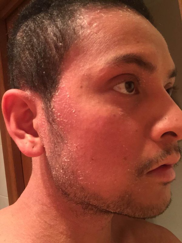 How I tapered down from 20 years of topical steroids TSW Assist