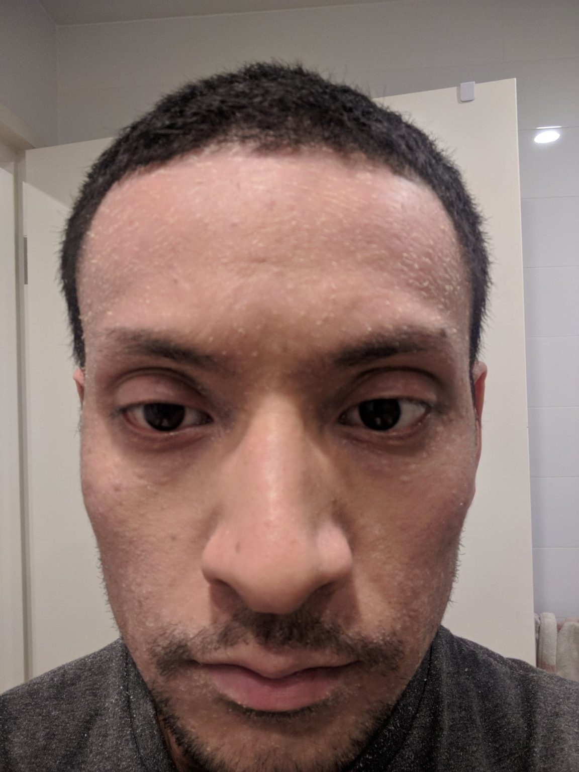 How I tapered down from 20 years of topical steroids TSW Assist