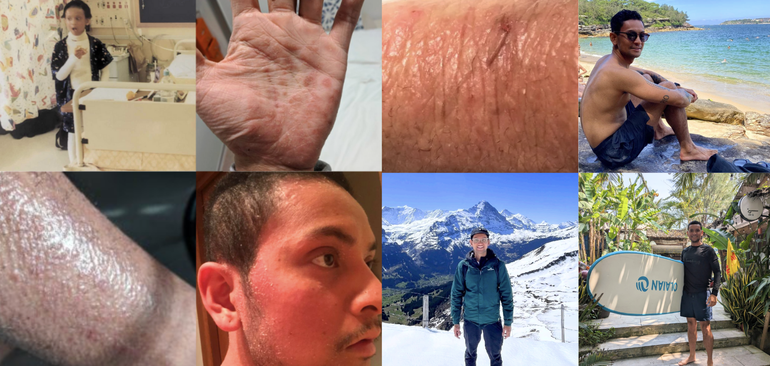 jason vergara tsw taper eczema